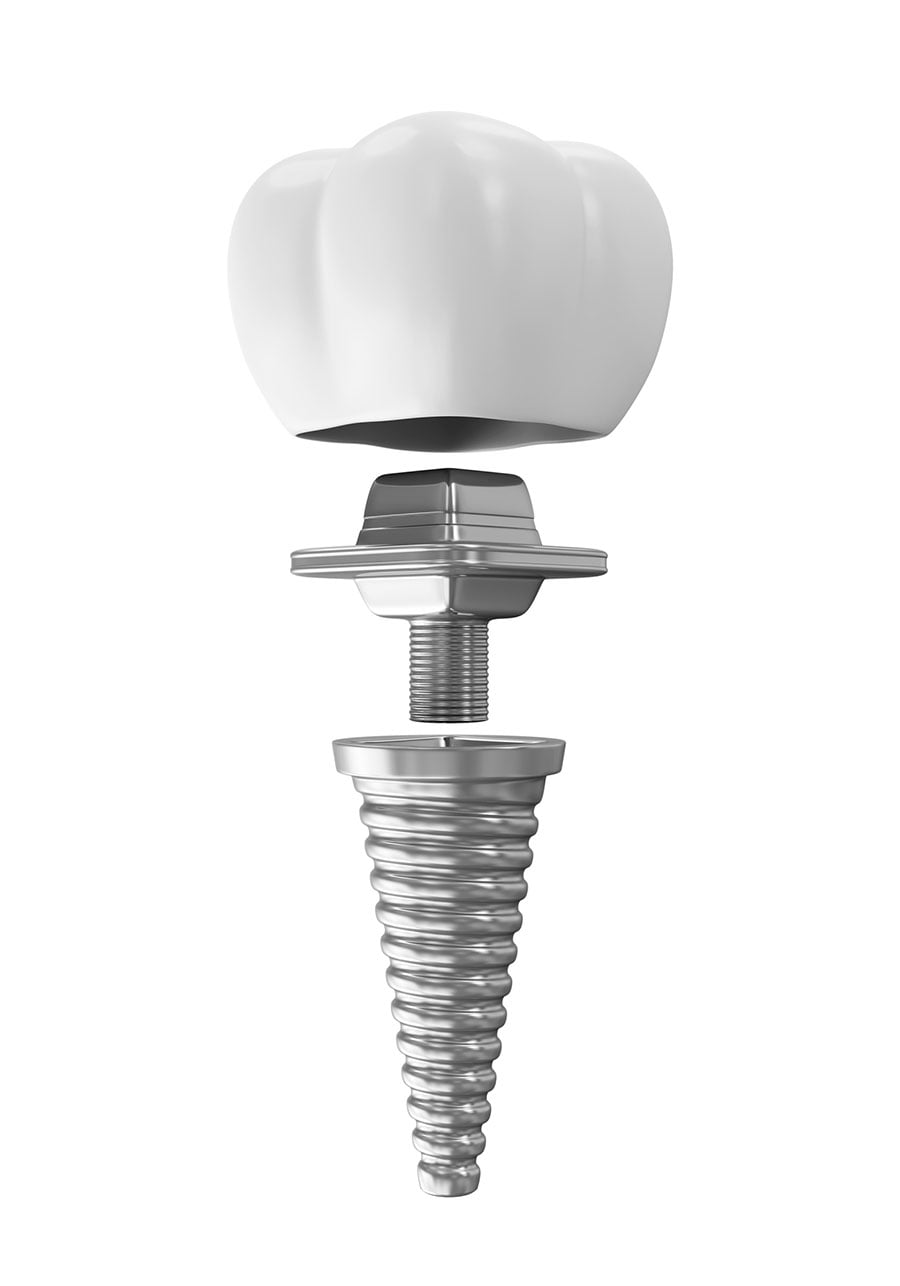 dental implants longevity full arch long term solution