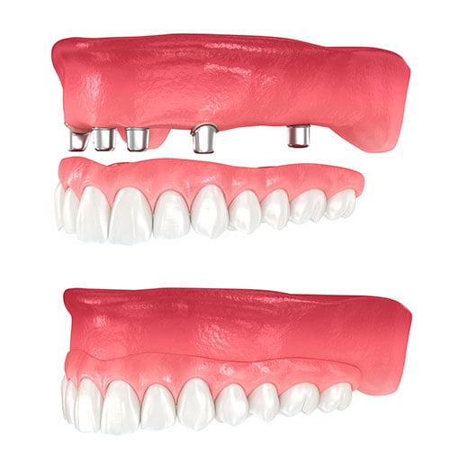 all on 4 teeth in a day full arch implant concept