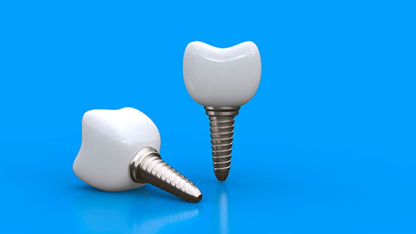 dental implant success factors planning placement experience