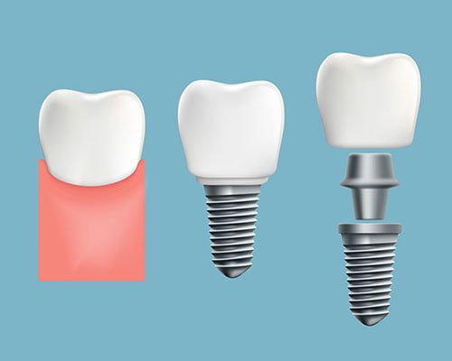 why patients choose dental implants missing teeth unstable dentures