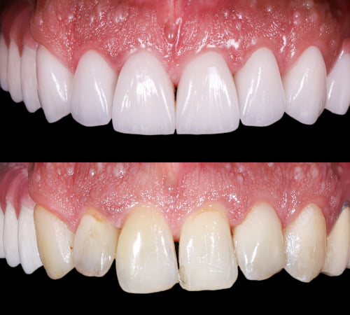 CBefore-and-after results of a smile makeover in North York, showing improved alignment, colour, and overall tooth transformation.