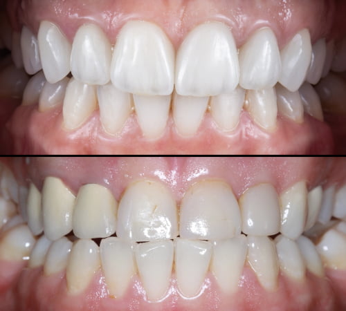 Ceramic veneers and crowns are used in a smile makeover in North York to improve tooth shape, colour, and symmetry.
