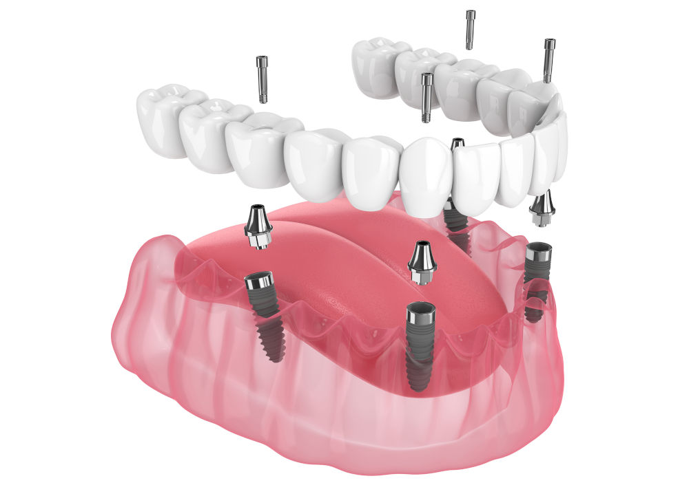 All-on-4 Dental Implants Cost in North York: Full Guide for 2026