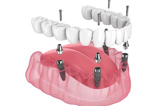 All-on-4 Dental Implants Cost in North York: Full Guide for 2026