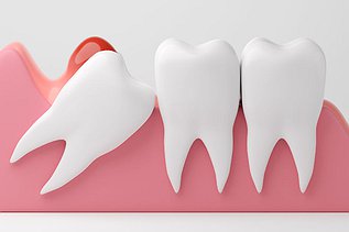 Is Wisdom Teeth Removal Covered by CDCP?