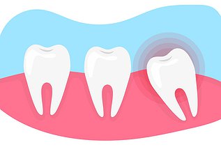 How Much Does Wisdom Tooth Removal Cost in Ontario?