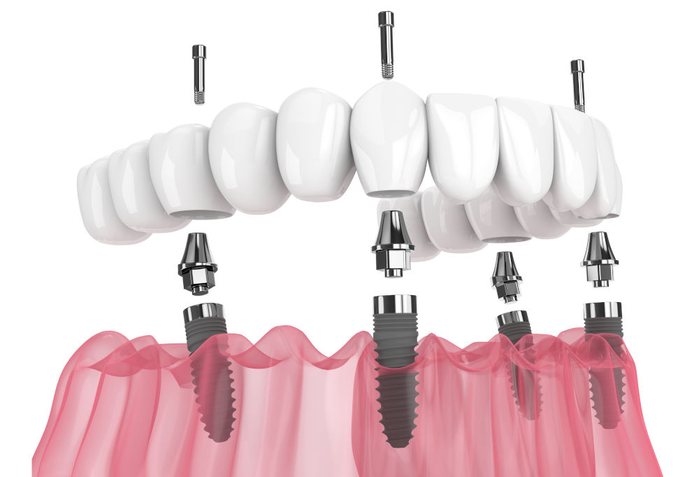 Cost comparison table for All-on-4 dental implants per arch and full mouth in North York, Ontario, for 2026