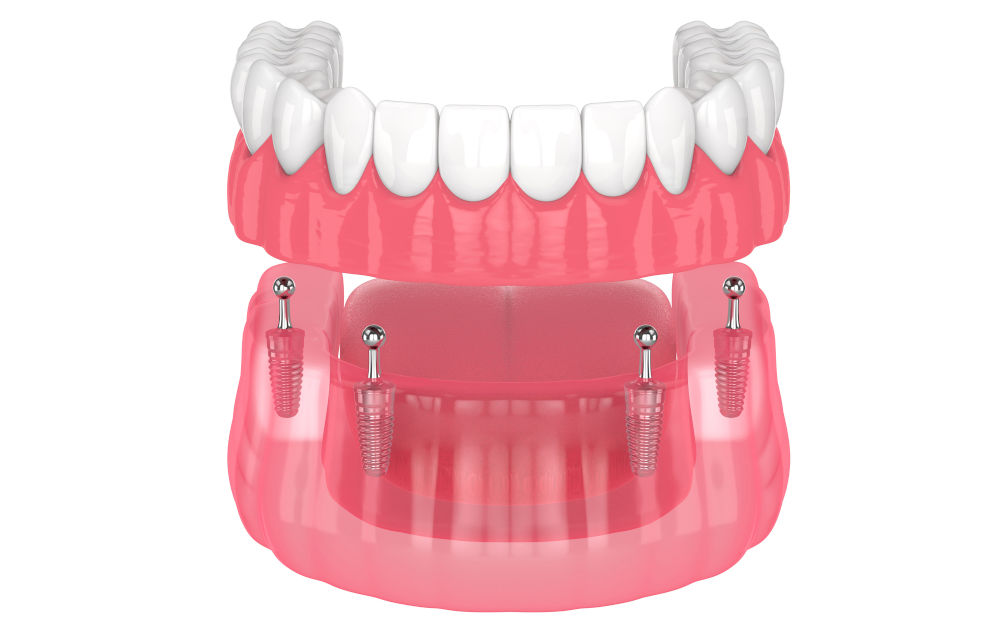 All-on-4 dental implants showing stability, bone preservation, and cost differences