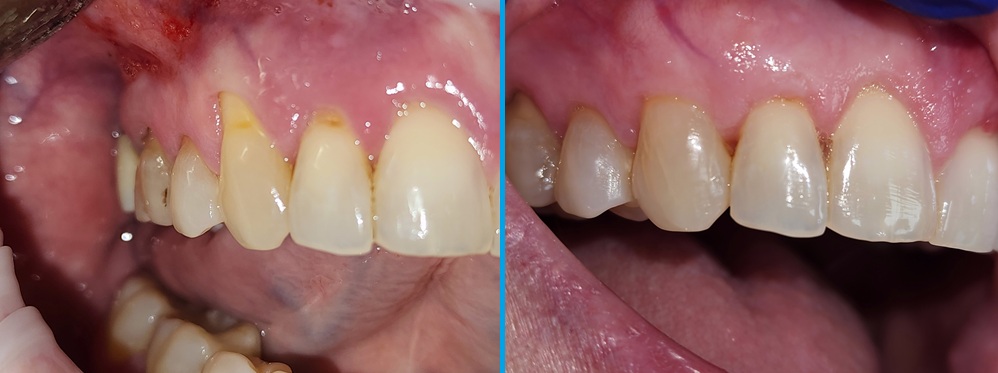 Gum recession before and after treatment at Bayview Smile Centre